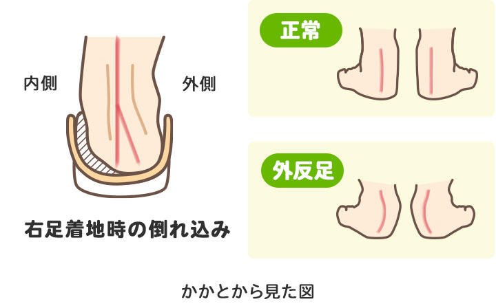 外反扁平足の図