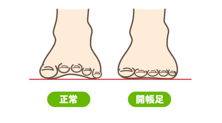 開張足・浮指の図